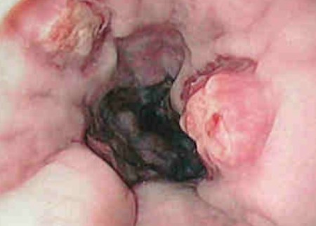 胃カメラによる食道潰瘍の写真