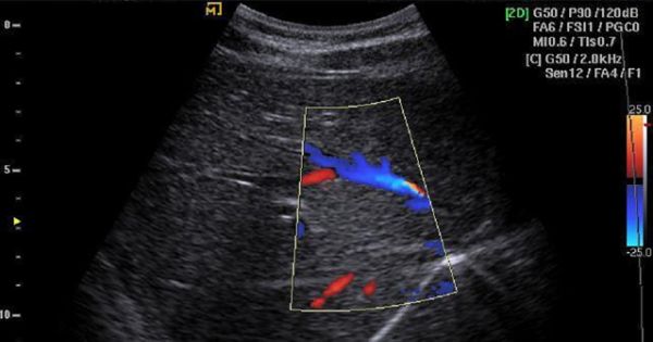 腹部超音波検査 胆石や肝臓がんの早期発見に役立ちます