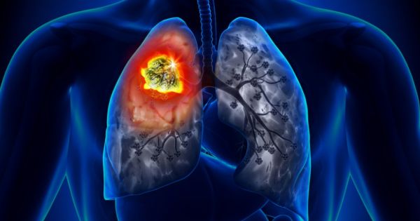肺の病気の診断に有用な胸部x線 レントゲン 検査